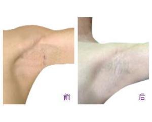 深圳美容 botox除腋臭有什么好处