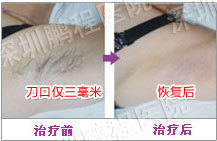 腋臭_腋臭治疗_腋臭医院-深圳鹏程医院