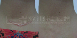腋臭疤痕-深圳鹏程医院疤痕修复 三甲服务标准疤痕修复机构 全国权威疤痕修复基地