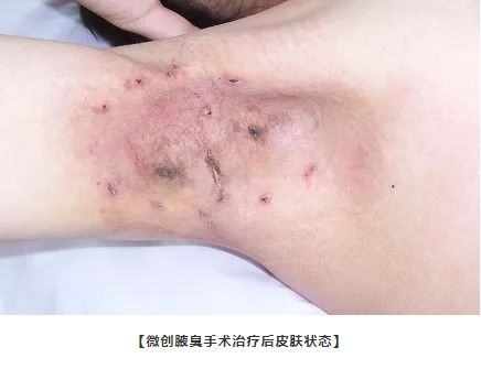居然还有人不知道,1次根除腋臭的miradry清新微波