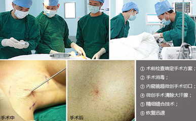 简单有效的治狐臭偏方 深圳腋臭的实用解决方案